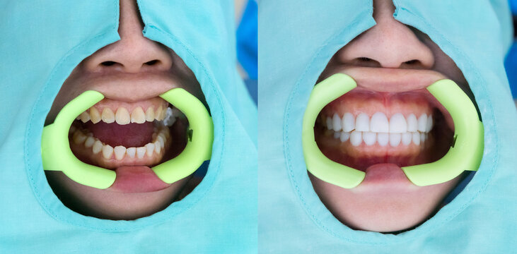 Natural look of smile makeover with dental ceramic veneers treatment, present of clean, props, youth and white teeth smile. Before and after close up smile.