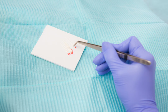 gutta-percha pins in a set of different sizes for filling root canals, one pin in close-up in dental tweezers, material for endodontic fillings. dentist in gloves