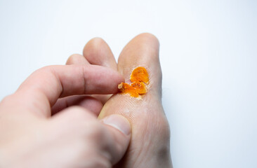 Contagious skin illness on foot. Medical treatment photo..Close up photo of plantar wart on man's foot. Salicylic acid plaster. Remove  Verruca plantaris.