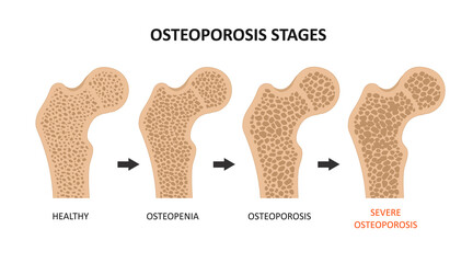 Osteoporosis stages. Bone spongy structure vector illustration, normal, osteopenia and osteoporosis - obrazy, fototapety, plakaty