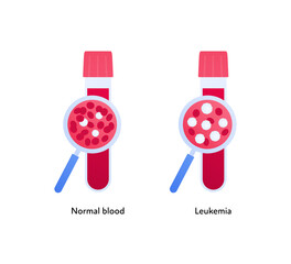 Leukemia cancer blood disease concept. Vector flat healthcare illustration. Test tube with magnifier glass isolated on white background. Normal and ill blood cell symbol. Design for oncology