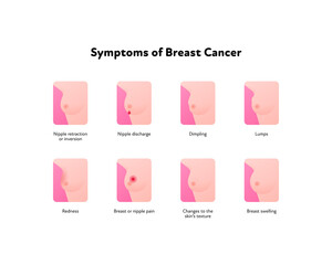Breast cancer symptoms infographic. Vector flat healthcare illustration. Set of icon symbol with symptom and text isolated on white background. Design for awarness month, poster