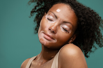 Young woman with vitiligo posing with her eyes closed