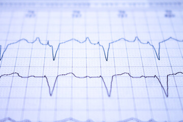Close-up of an EKG tracing of a patient with a cardiac pacemaker. Pacemaker beats