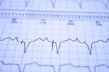 Close-up of an EKG tracing of a patient with a cardiac pacemaker. Pacemaker beats recorded on paper.