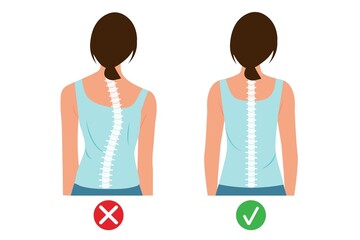 Woman's body and backbone.Infographic illustration of back view woman representing correct column scoliosis and scale of curvature Vector illustration. - obrazy, fototapety, plakaty