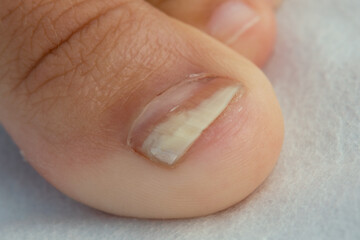 Close up image of a finger with nail fungus infection.