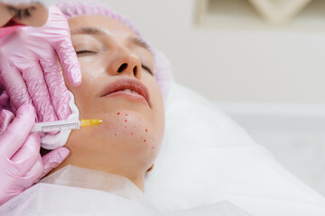 Cosmetic procedure for biorevitalization and removal of wrinkles for a young beautiful girl....