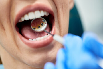 Close-up of woman having check-up of dental braces on back side of her teeth at dentist's office.