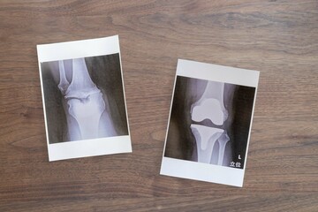 病院の診察で写した膝レントゲン写真,...