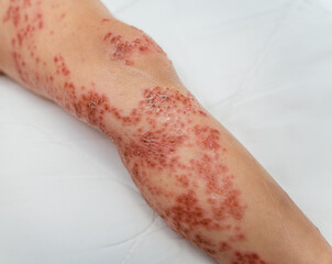 Close up enterovirus on baby body