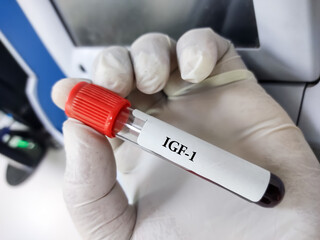 Technologist holds a blood sample for IGF-1(Insulin-like growth factor-1) Test, Hormone Test, GH...