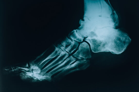 X-ray of the foot. Leg injury