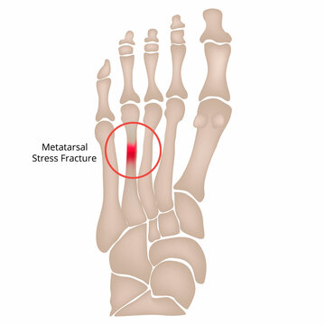 Stress fracture. Marching fracture of the foot. Fracture of the metatarsal bones in the foot. Anatomical structure of the foot. Skeleton. Broken bones. Vector illustration on isolated background.