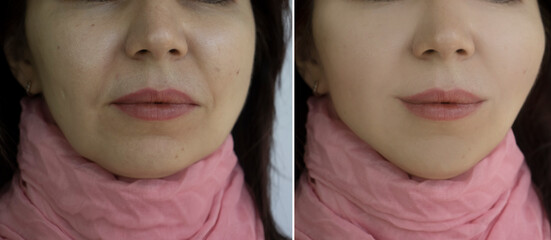 woman face wrinkles before and after treatment, double chin - obrazy, fototapety, plakaty