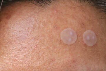 Acne pimple patch to get rid of zits on face