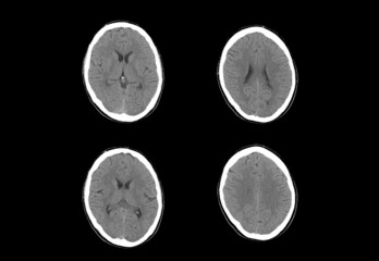 Brain ct scan and MRI images