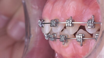 Dental tooth brackets In-Oral Photo  Protocol