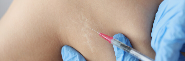 Doctor in gloves injecting medicine into scar on skin of patient leg closeup