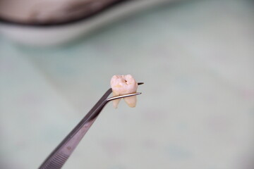 Extracted tooth in tweezers against the background of a dental tray