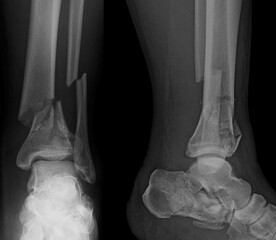 x ray of a broken foot  cominutive fracture on tibia and fibula - obrazy, fototapety, plakaty