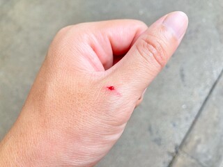 Drops of blood on the wound of the hand