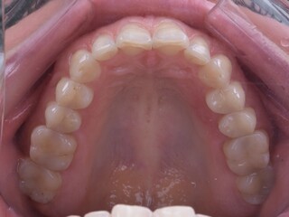 Tooth In-oral Photo