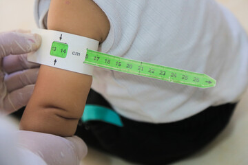Measuring malnutrition using strap MUAC mid-upper-arm-circumference. A doctor examines child malnutrition - obrazy, fototapety, plakaty