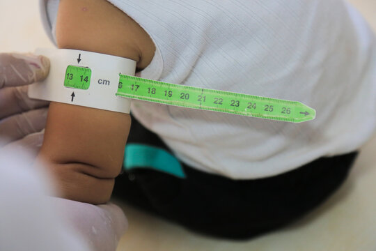 Measuring malnutrition using strap MUAC mid-upper-arm-circumference. A doctor examines child malnutrition