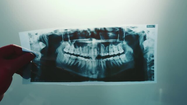 X-ray examination of the jaw. The doctor examines a panoramic image of the jaw. X-ray in dentistry