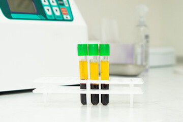 Three medical test tubes with blood plasma stand on the  table on background of the medical office. Concept of a laboratory blood test. aesthetic cosmetology injections of plasma for skin lifting. - obrazy, fototapety, plakaty