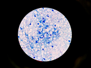 Pulmonary Tuberculosis ( TB ) : Sputum AFB stain microscopic image. To diagnosis mycobacterium tuberculosis infection. MTB mycobacterium tuberculosis  3+