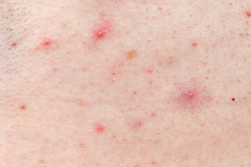 Skin background texture with pimples and blackheads. problematic skin close up. acne diseases