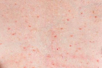 Skin background texture with pimples and blackheads. problematic skin close up. acne diseases