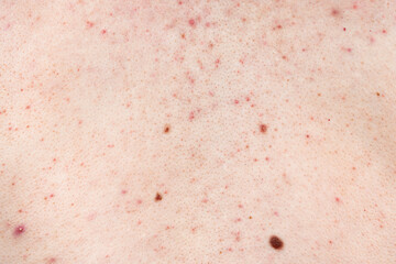 Skin background texture with pimples and blackheads. problematic skin close up. acne diseases