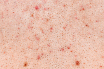 Skin background texture with pimples and blackheads. problematic skin close up. acne diseases