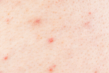 Fototapeta premium Skin background texture with pimples and blackheads. problematic skin close up. acne diseases