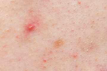 Fototapeta premium Skin background texture with pimples and blackheads. problematic skin close up. acne diseases
