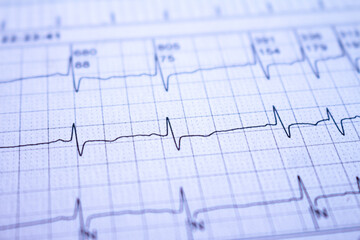 Close-up of an electrocardiogram of a patient. Heartbeats recorded as waves on paper.
