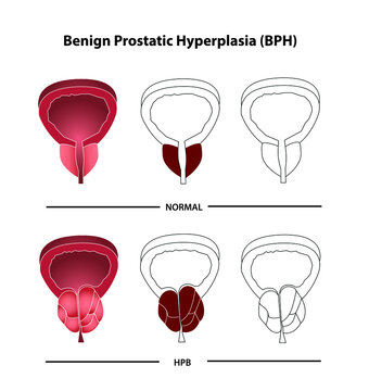 Benign prostatic hyperplasia.
Hiperplasia prost&aacute;tica benigna
