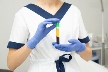Close up Medic woman  hand in blue medical gloves holds test tubes with blood plasma. Concert of laboratory blood tests and cosmetic injections for the beauty of skin and hair. - obrazy, fototapety, plakaty