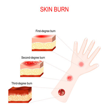 types of burns. Cross section of humans skin