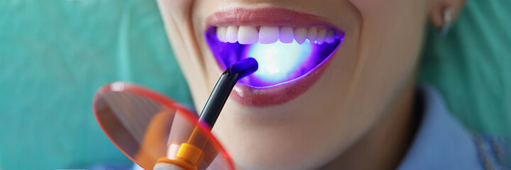 Dentist doctor fills patient teeth with curing light closeup