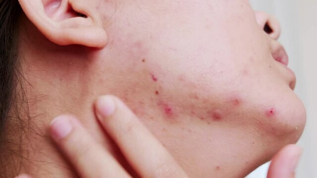 Young women with problematic skin and pimples on her face. Female showing her acne. Skincare, beauty and spa concept.