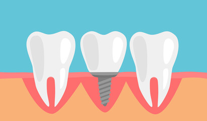 Human teeth and dental implant in flat design vector illustration.