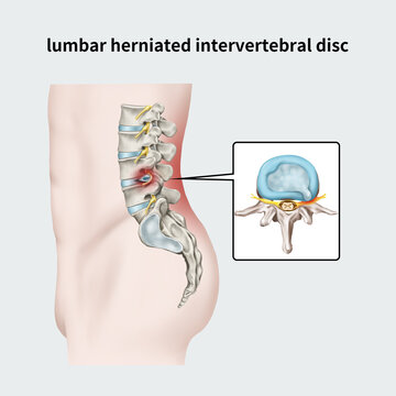요추추간판탈출증 lumbar herniated intervertebral disc
