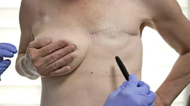 Preparing for breast reconstruction for a woman undergoing mastectomy. Breast plastic surgery after mastectomy.