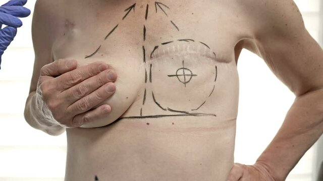 Preparing for breast reconstruction for a woman undergoing mastectomy. Breast plastic surgery after mastectomy.