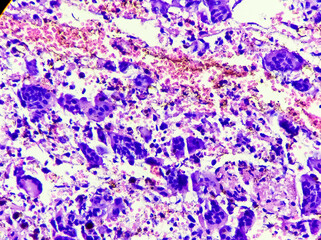 Osteoclast like giant cells. Light micrograph of a giant cell tumour of lower end of right femur...