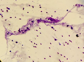 Cytopathology Tissue form breast, microscopic image of granulomatous mastitis, histology
